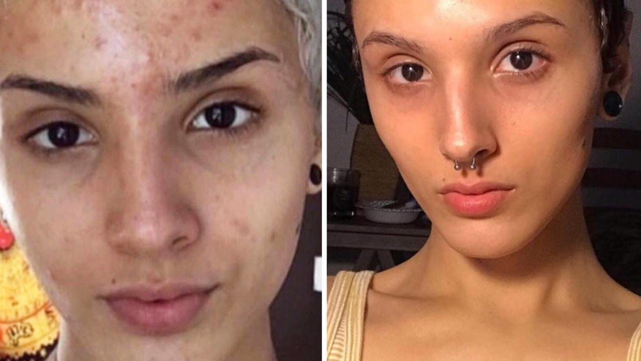 Acne treatment: Woman cures severe acne spots with simple trick | The