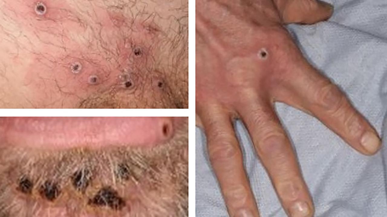 A collage of monkeypox rash lesions. Picture: UK Health Security Agency/AFP