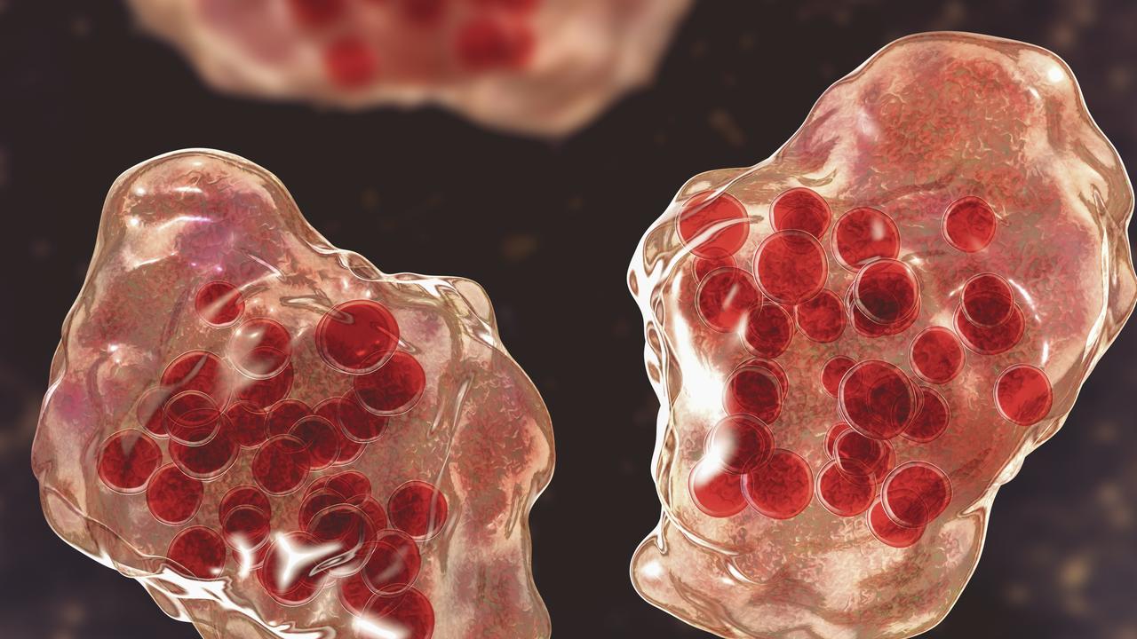 Illustration of measles virus infection showing giant multinucleated cells seen during microscopy of biopsy specimens, known as Warthin-Finkeldey giant cells.