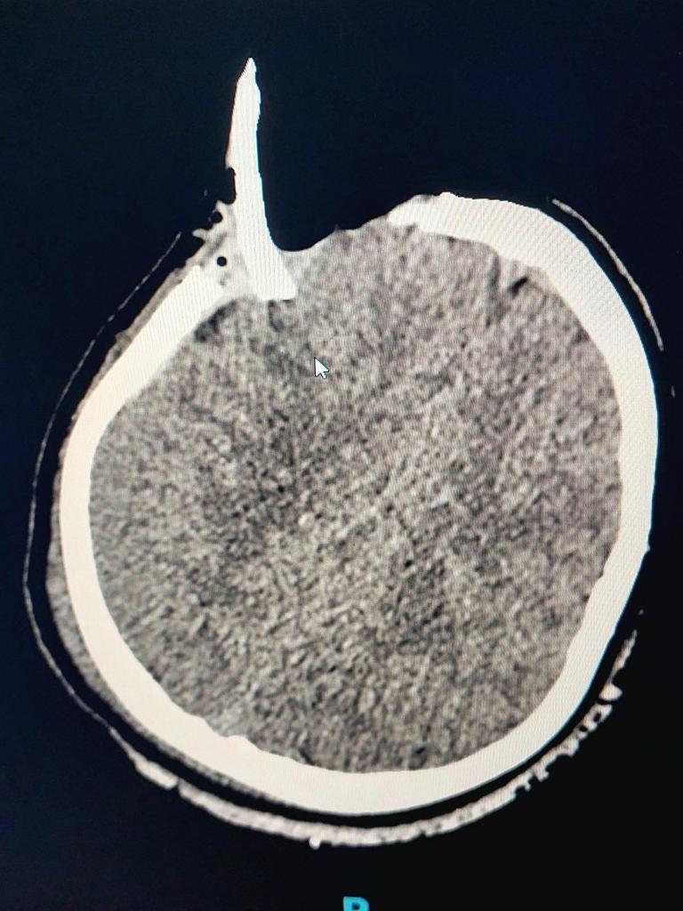 An x-ray of Hamish’s skull after the accident. Picture: Contributed