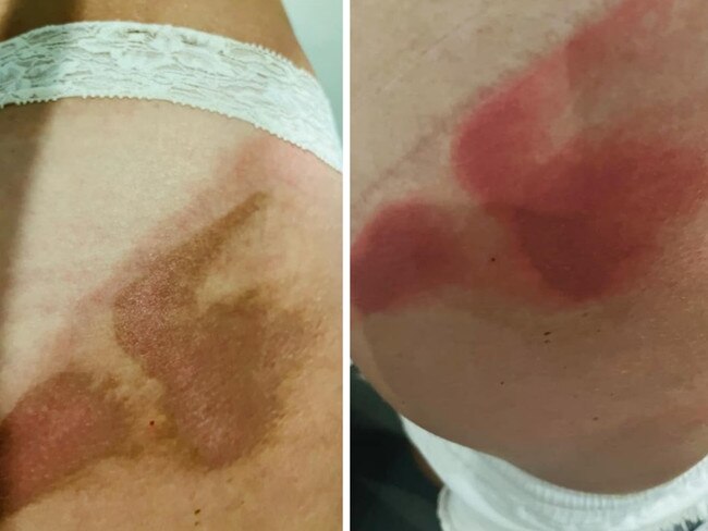 Aussies holidaying in Bali are warning fellow travellers to be mindful of a venomous beetle that can cause horrible burn-like scars and blisters on the skin.