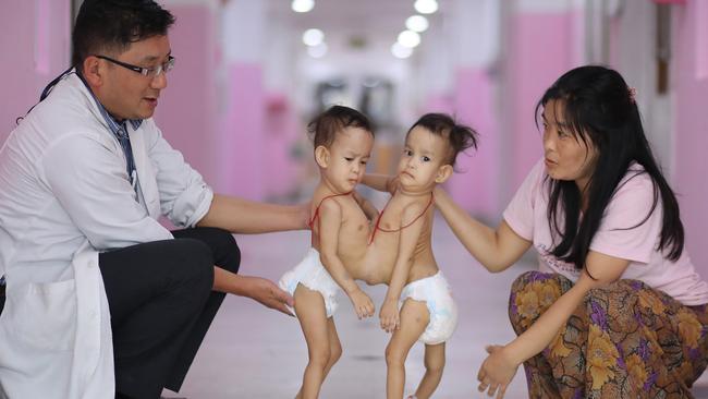 The twins before their surgery. Picture: Alex Coppel