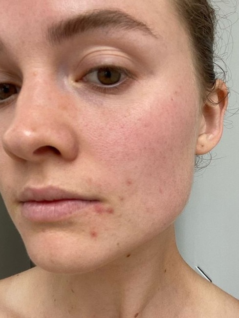 The Keep It Cleaner co-founder also shared this snap in April showing breakouts around her mouth, chin and my hair line. Picture: Instagram/LauraHenshaw