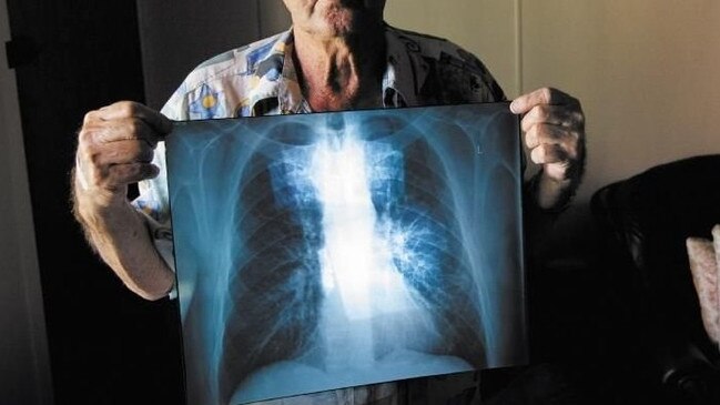 BLACK LUNG: Percy Verrall was diagnosed with black lung disease in 2015. He was the first Australian diagnosed with the disease in 30 years.