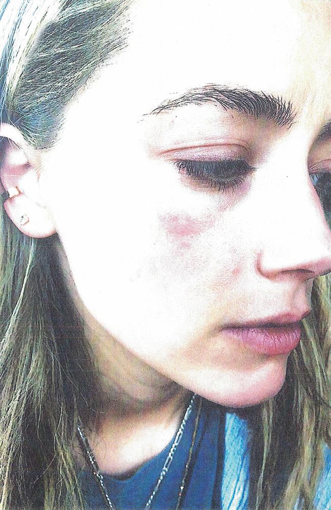 Bruising on Amber Heard's face she claims was inflicted by Johnny Depp.