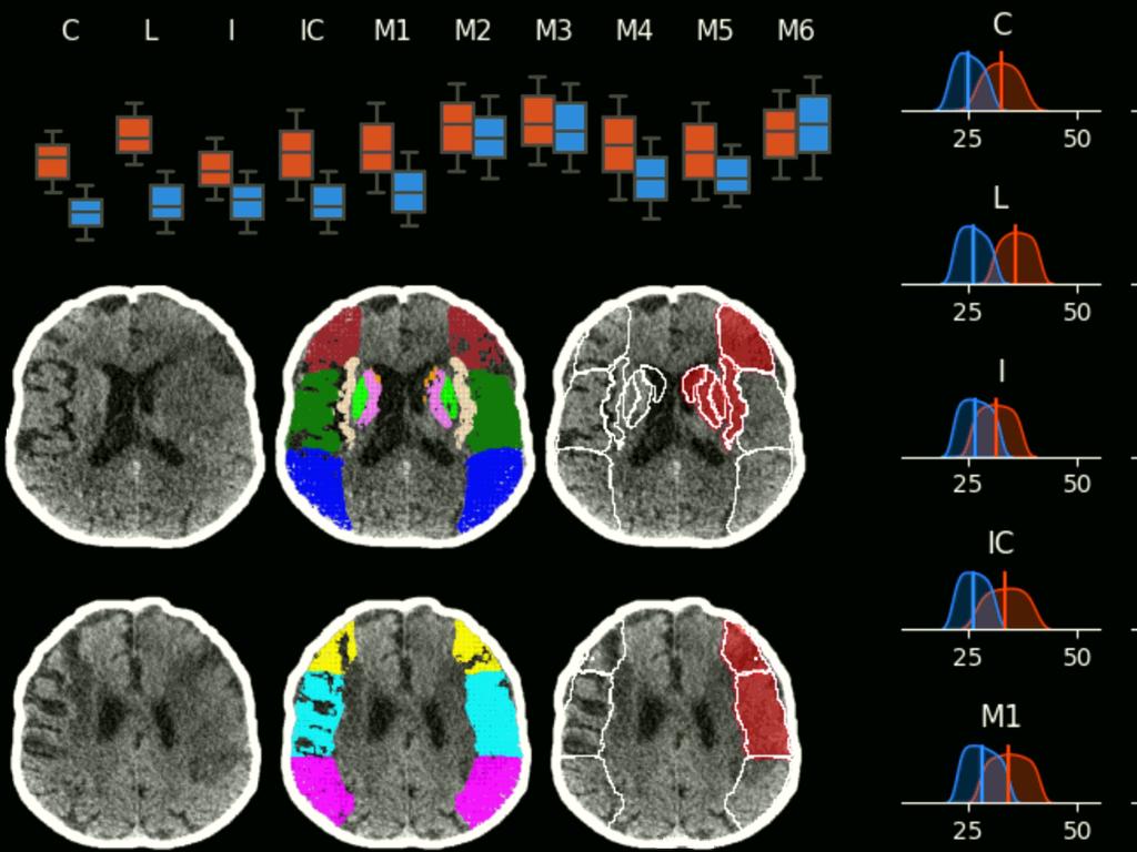 StrokeViewer can help doctors diagnose and determine brain tissue that can be saved after a stroke. Supplied