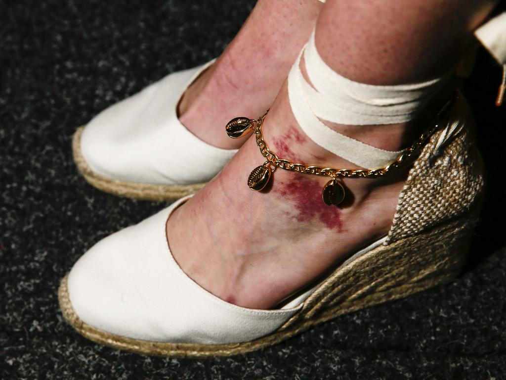 Behind the scenes at Fashion Week at Carriageworks. Bruises on the feet. Picture: Dylan Robinson