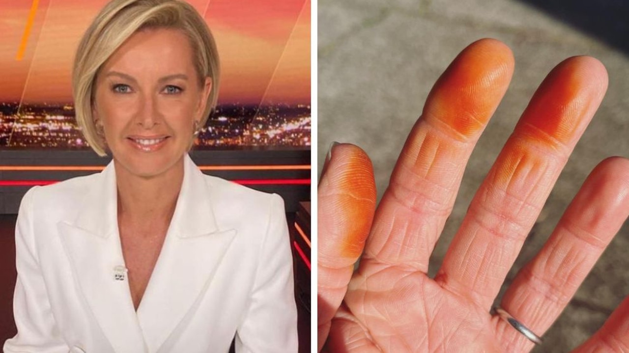 ‘Disgusting’ cause of Channel 9 star’s yellow fingers