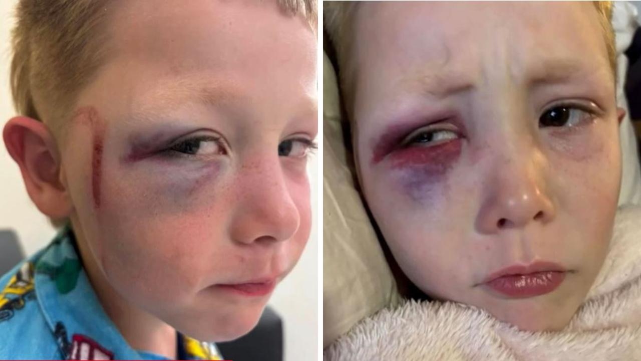 ‘Thought he was going to die’: Boy allegedly bashed with golf club by another kid