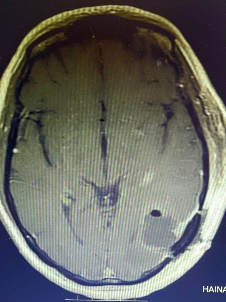 Mrs Miles’ scan after Dr Teo performed surgery in China. She said there was no contrast, just a black hole where the tumour had once been. She will now undergo radiation. Picture: Supplied