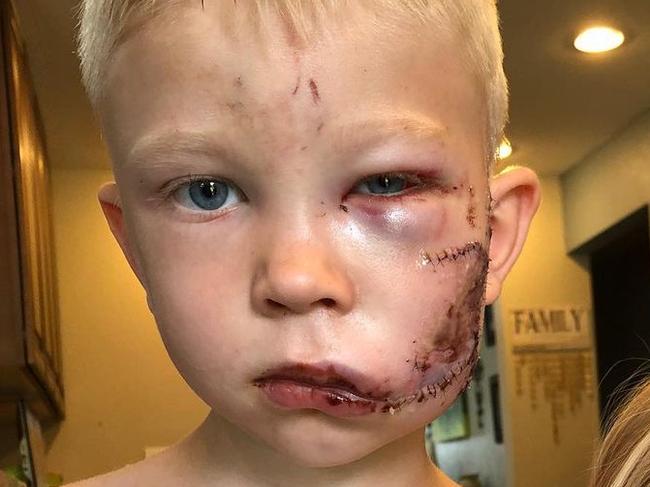 Boy mauled by dog saving sister unveils incredible transformation. Picture: Instagram/nicolenoelwalke