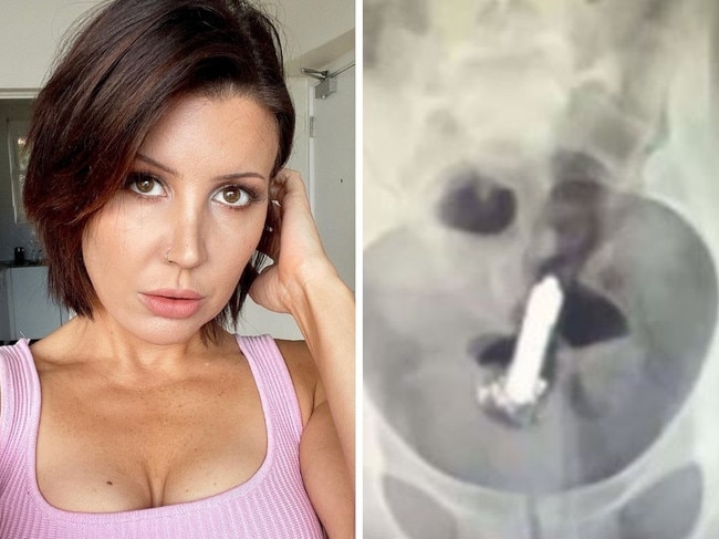 X-ray reveals woman’s sex toy horror