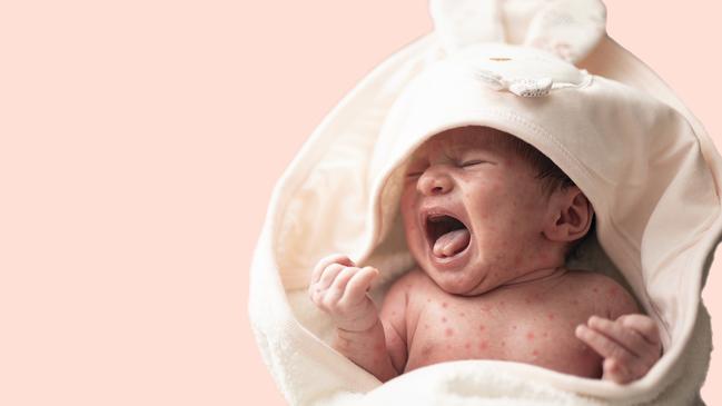 NSW Health has alerted residents to a confirmed case of measles on a flight to Sydney from Vietnam, who was infectious at the time. Picture: iStock