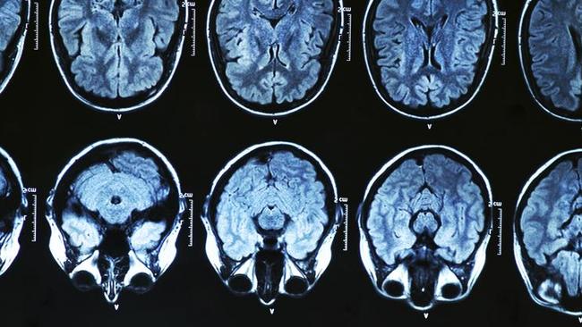 The new technique uses sonic stimulation to excite the neurons in the thalamus, the brain’s central hub for processing information.