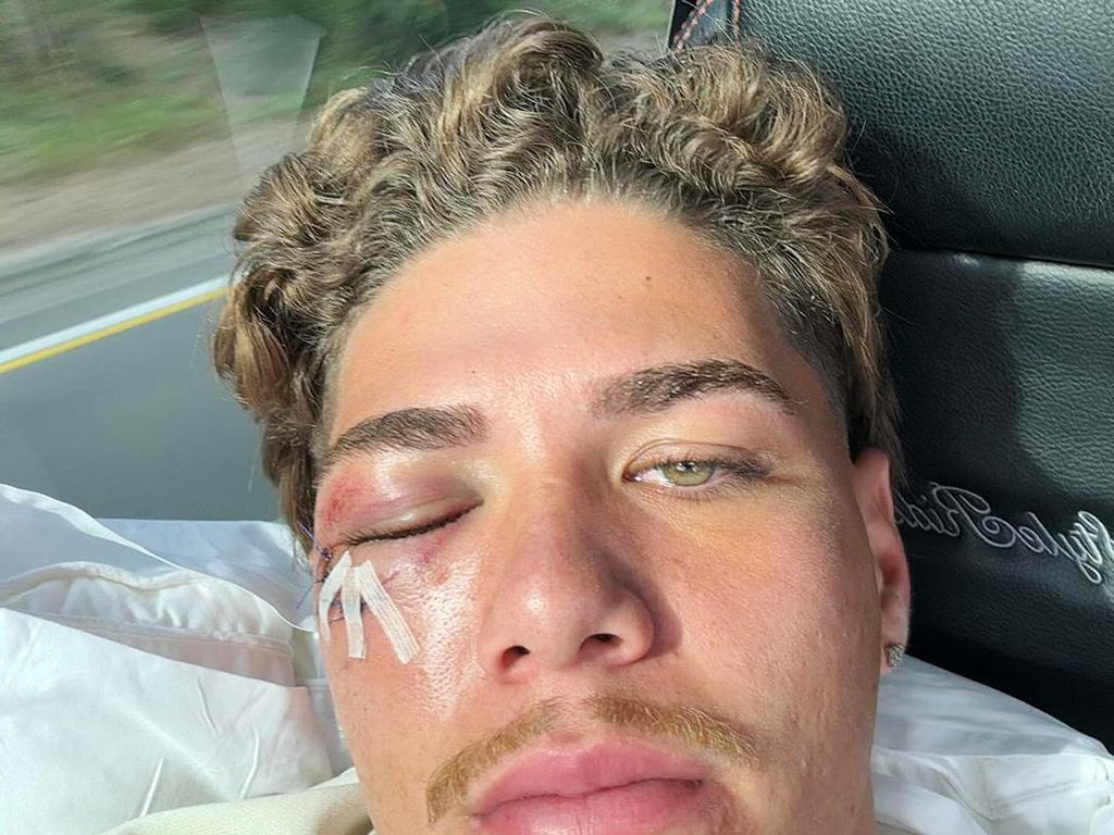 Brisbane Broncos star Reece Walsh is facing at least four weeks on the sidelines after suffering a facial fracture in Thursday night’s grand final rematch loss to Penrith. Photo: Instagram.