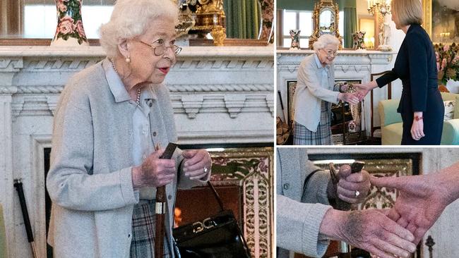 Photographs of the Queen taken when she met new PM Liz Truss showed she had a bruise on her right hand but this is thought to be a benign condition of old age.