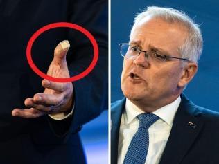 Mystery of ScoMo’s injured thumb