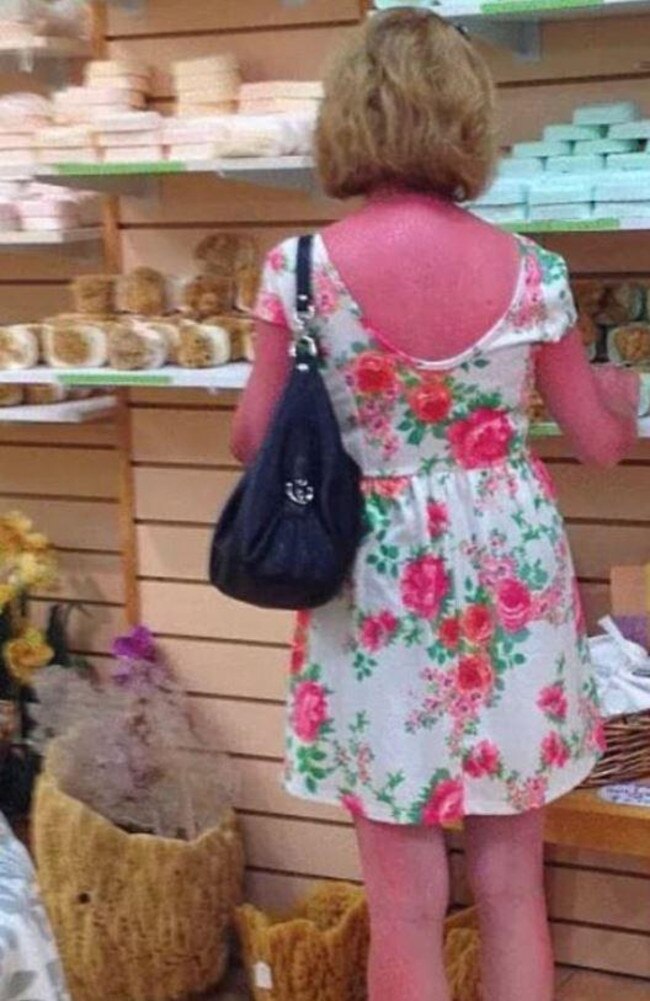 One woman bravely shops for holiday gifts, despite having a traumatic case of sunburn.