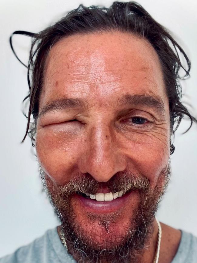 Matthew McConaughey shares a photo of his swollen face.