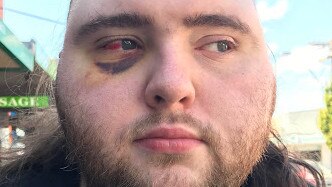 Autistic man Andrew Head, 29, from Oakleigh South was left with a black eye after he became involved in a fight with an arborist. Picture: Supplied