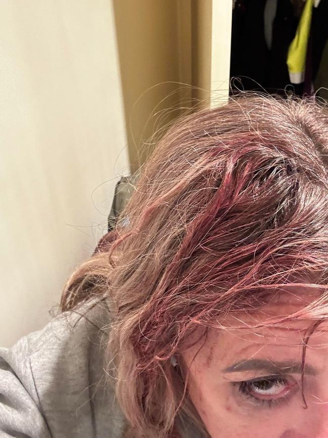 Caitlin Morrison, 45, was assaulted on a Melbourne tram on April 22. Picture: Supplied