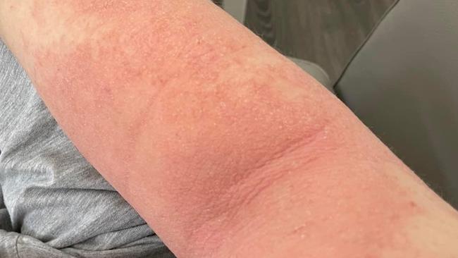 Rashes on Michelle Kate. Picture: Supplied