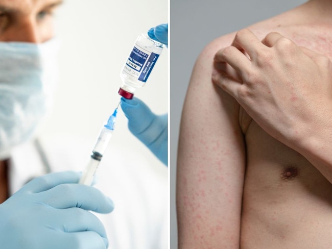 Public health alert: Potential measles exposure in Cairns. Picture: iStock.