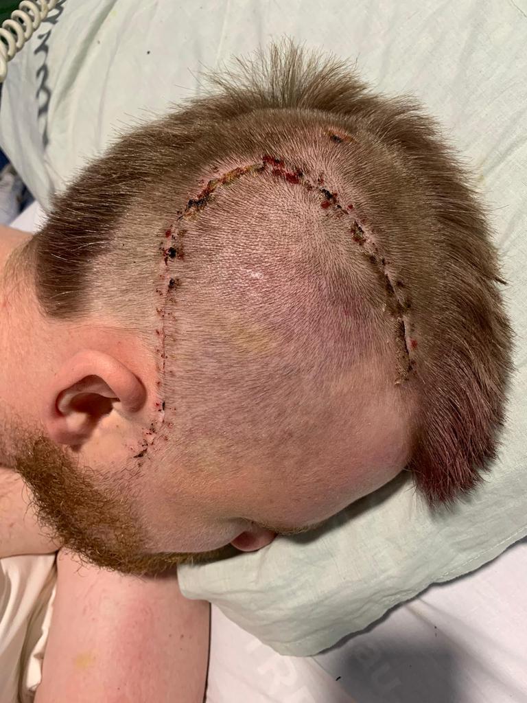 Harry Frolling bears the scars of surgery to repair his fractured skull and alleviate bleeding on the brain. Picture: Shane Froling/Twitter