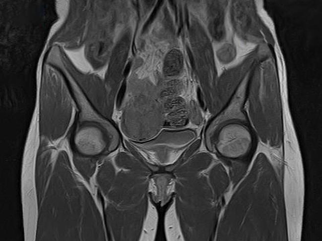 Magnetic resonance imaging can be used to help diagnose endometriosis and assess how advanced is the disease. Picture: iStock
