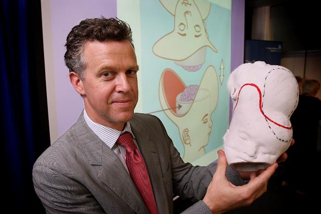 <p>Andrew Greensmith, plastic and maxillofacial surgeon, holds a head cast of the twins, showing the skin and skull separation to be performed. Picture: David Caird</p>