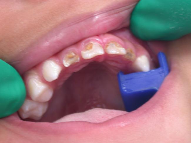 Children are suffering from more tooth decay, mostly due to sugar intake.