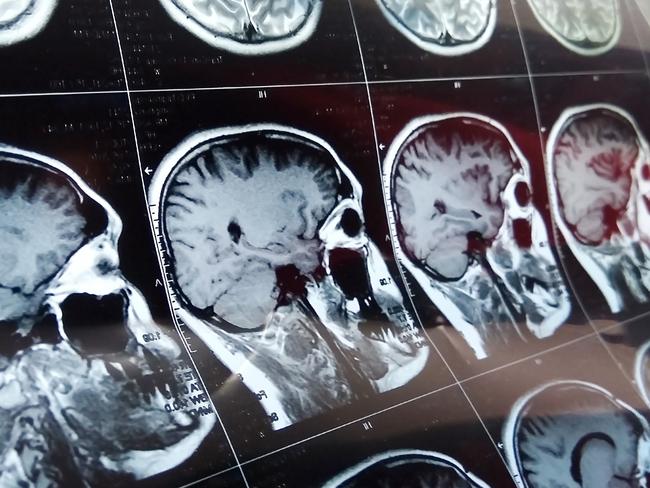 Experts have identified six main symptoms of brain cancer. Picture: iStock