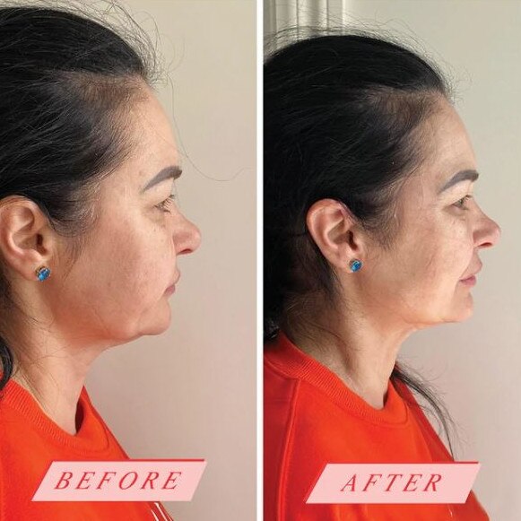 This woman's double chin appears reduced. Picture: Instagram