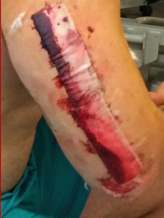 Patched up after the op.