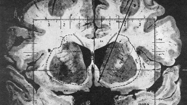 Electrodes on B-19’s brain. Picture: Pleasure and Brain Activity in Man report