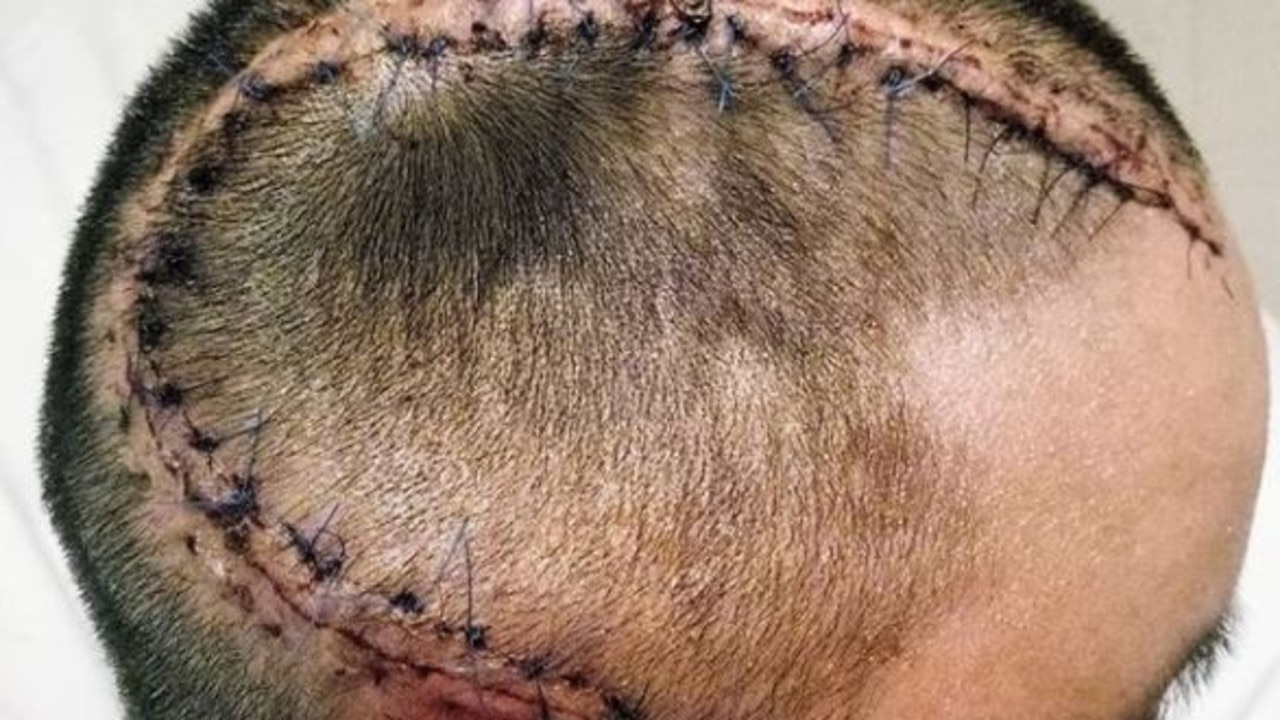 Nathan Nguyen had a large portion of his skull removed to relieve pressure on his brain.