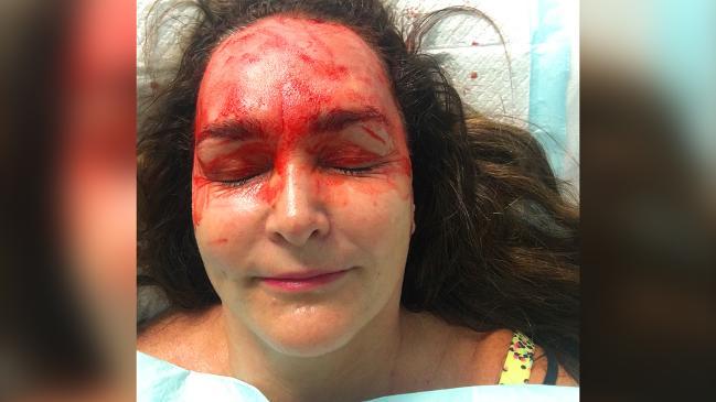 Kate Langbroek's vampire facial