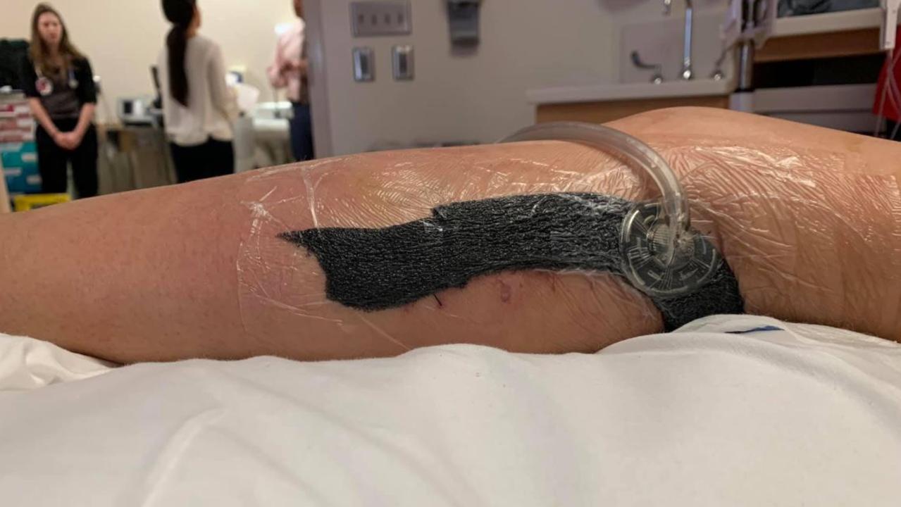 Doctors determined it was flesh-eating bacteria. Picture: Michelle Hill
