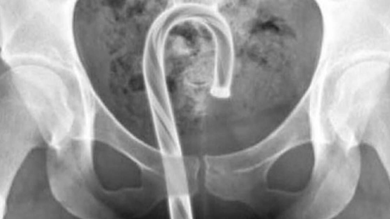 Masturbating With Christmas Ornaments X Rays Expose ‘stupid Sex Trend