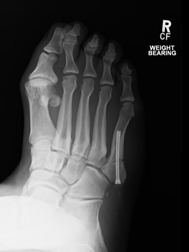 A scan of Tevita Tatola's first foot surgery. Picture: Supplied.