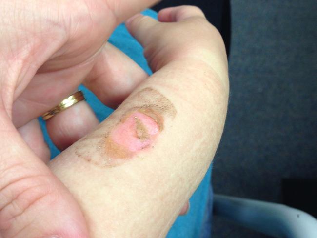 The arm of Caitlin Brennan, then 1, who was burned by liquid from the family's Thermomix. Picture: Supplied.