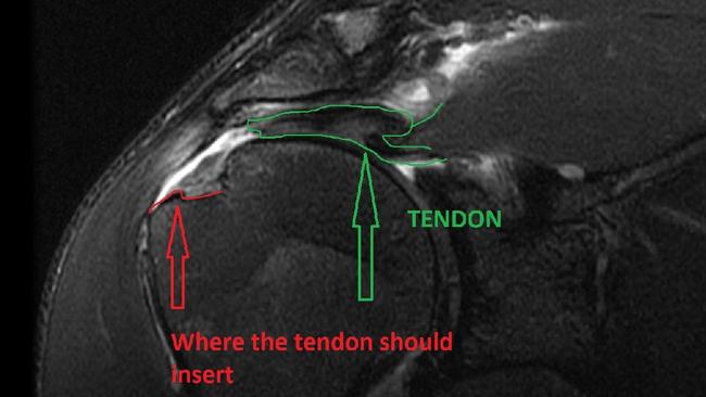 A scan of Thurston’s shoulder should where his tendon should have been.