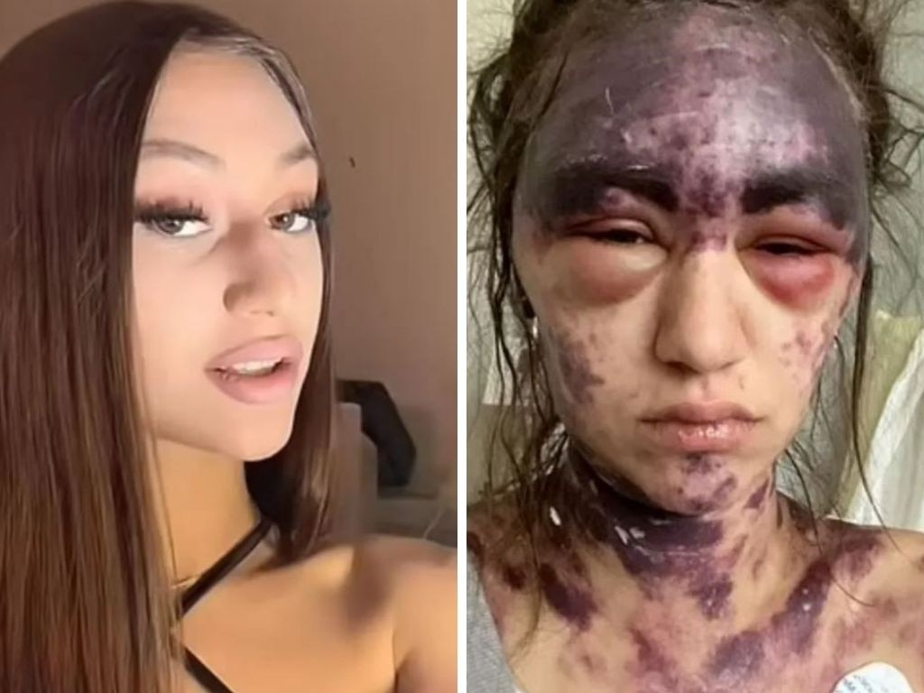 Alexis Lorenze, 23, suffered a rare reaction after having three vaccines at once. Doctors believe the reaction was likely exacerbated by her blood disorder. Picture: Facebook