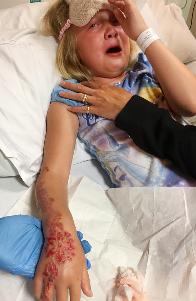 Madison Gulliver horrific chemical burns. Picture: SWNS/MEGA