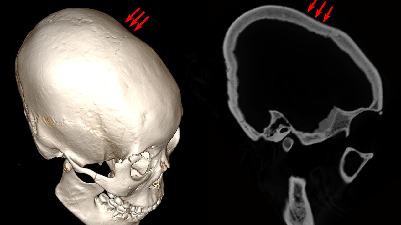 Деформируется ли череп от наушников. Искусственная деформация черепа.