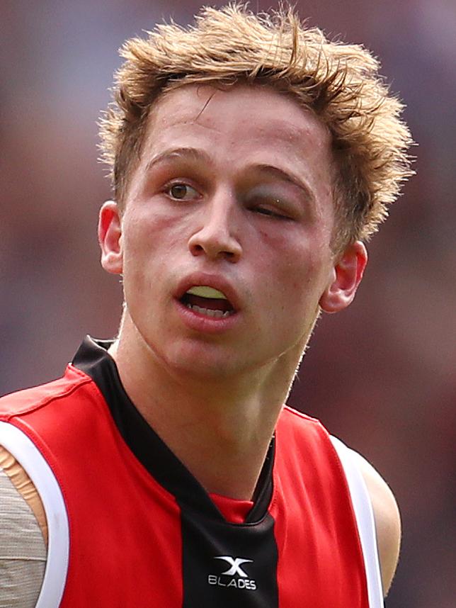 Jack Billings copped a serious shiner against Melbourne. Picture: Michael Klein