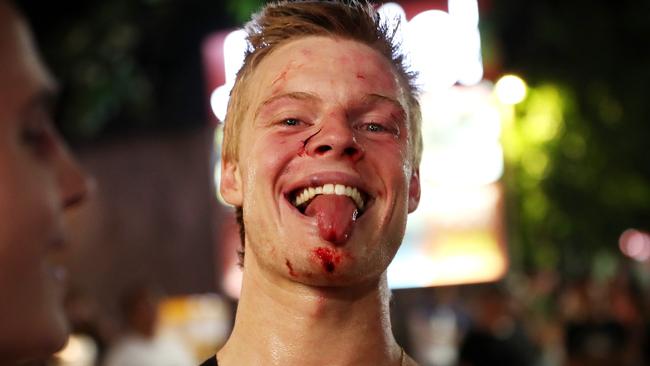 The bloody face of a young Australian after fighting in the Kuta nightclub district. Picture: Liam Kidston.