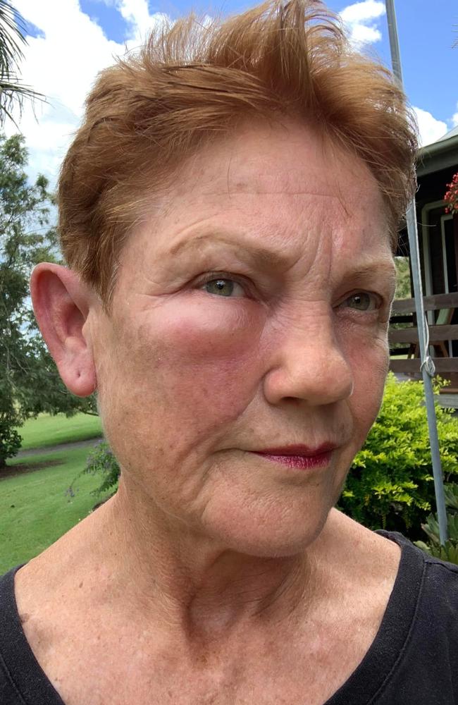 Her face and arms have fallen victim to multiple wasp stings. Picture: Facebook