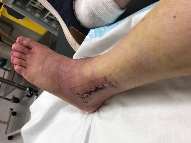 After surgery, Eli Klein says his injuries are "healing well".