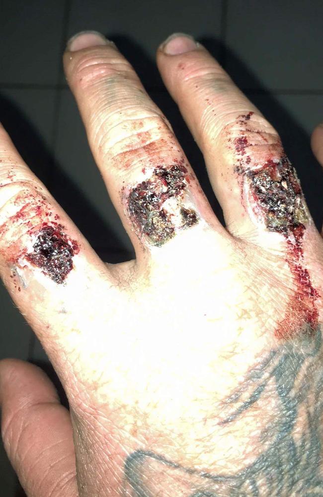 Tattoo removal gone wrong: 'I got a tattoo and ended up with third degree burns'